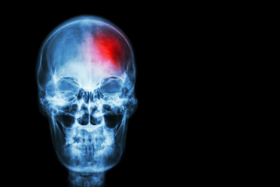 X-ray of human skull showing stroke.