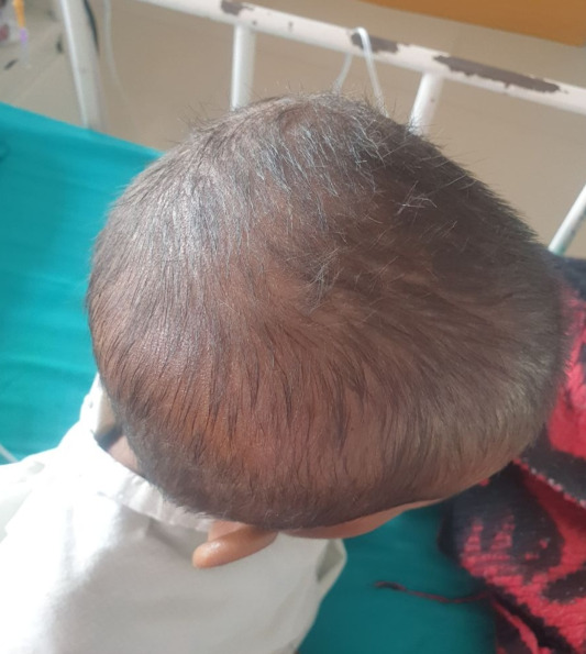 Child's head showing hair thinning due to trichotillomania.