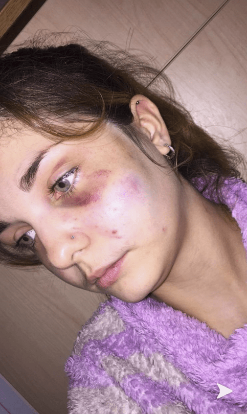 Close-up of a woman's bruised face.