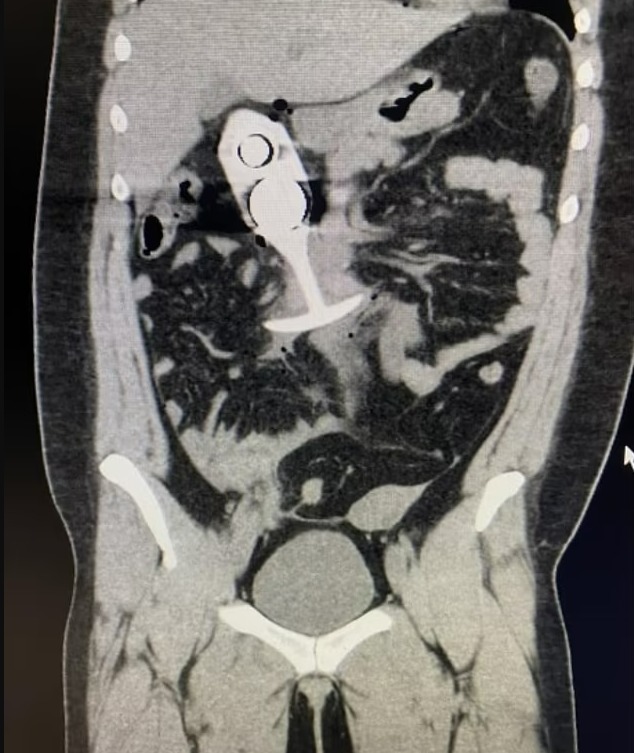 CT scan showing a sex toy lodged in a patient's rectum.