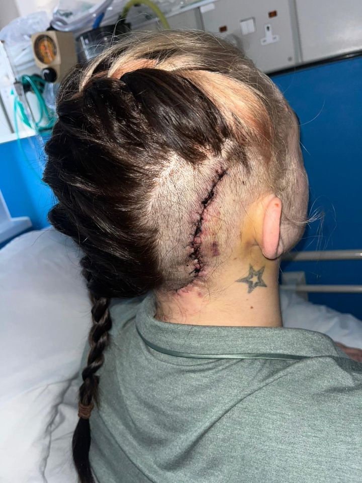 Woman's head with stitches from brain tumor surgery.