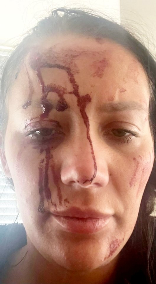 Close-up of a woman's face with blood and injuries.