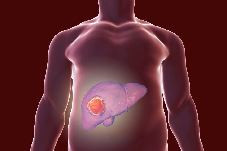 Illustration of a liver tumor.