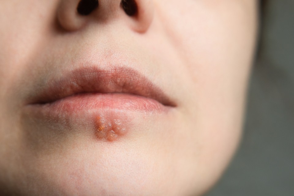 Close-up of a cold sore on a woman's lip.