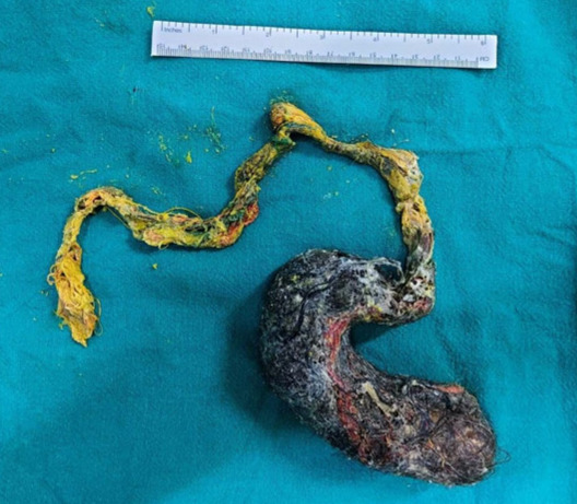 Stomach-shaped mass of hair removed from a child's stomach.