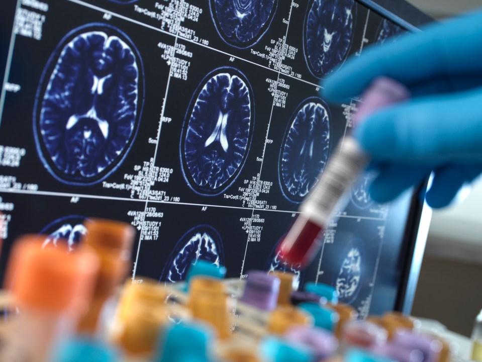 Blood sample and brain scans during Alzheimer's research.