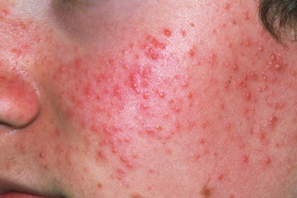 Close-up of acne on a person's face.