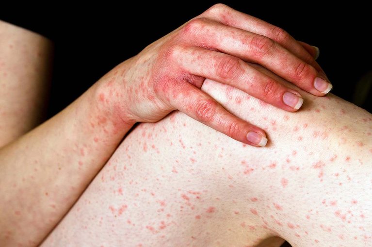 Hives rash on a person's arm and leg.