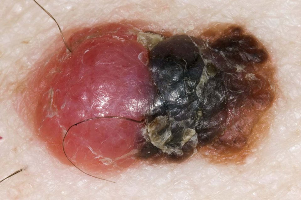 Close-up image of a melanoma skin cancer lesion.