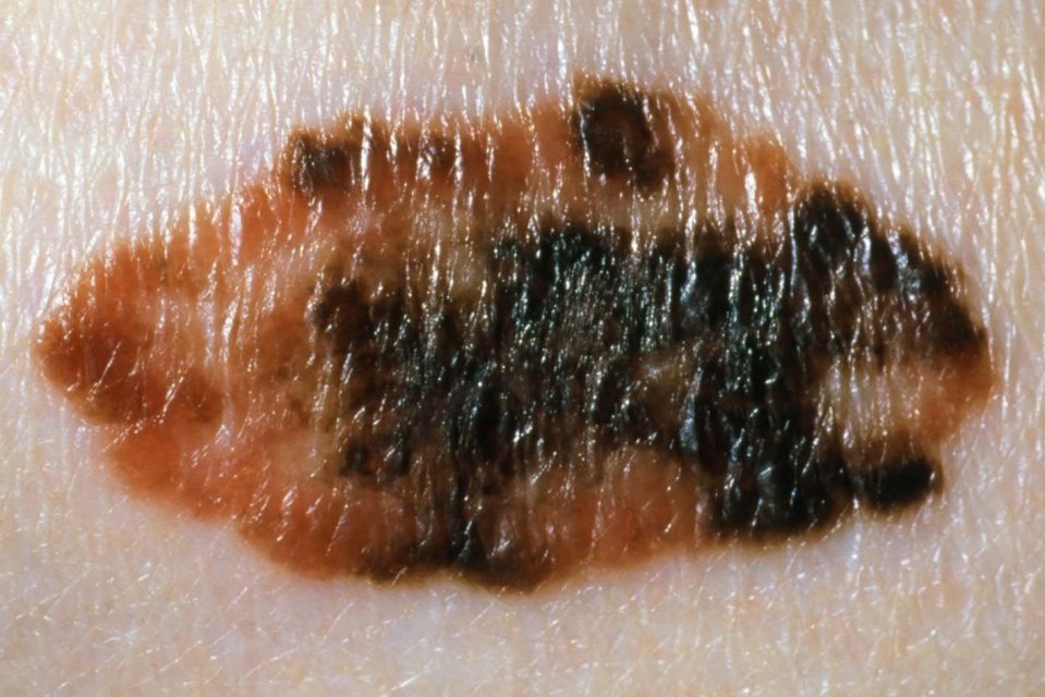 Close-up of melanoma skin cancer.